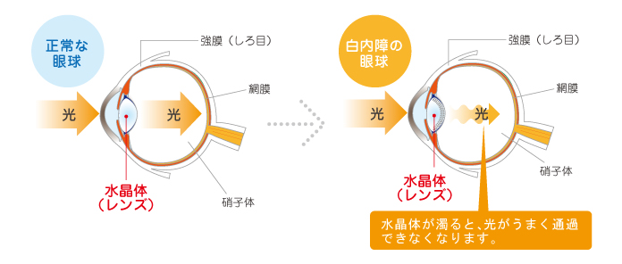 白内障の症状のイメージ