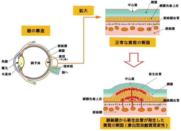 加齢黄斑変性の病態イメージ