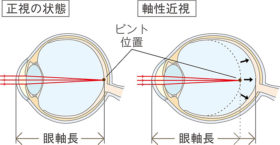 眼軸長が伸びてしまうイメージ