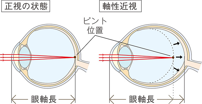 眼軸長が伸びてしまうイメージ