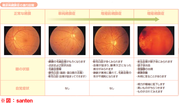 糖尿病網膜症の進行イメージ