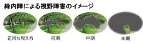 緑内障の視野障害の進行イメージ