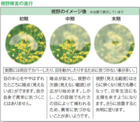 緑内障の視野障害の進行イメージ