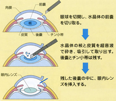 白内障日帰り手術の術式のイメージ